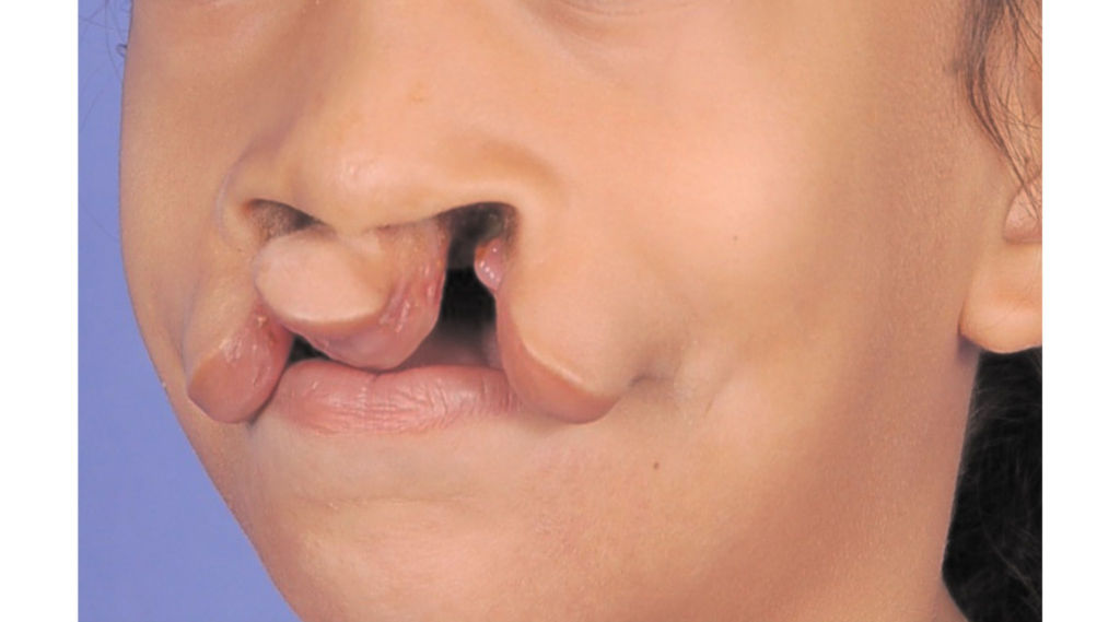 Tudo sobre lábio leporino: desvendando mitos sobre a anomalia!