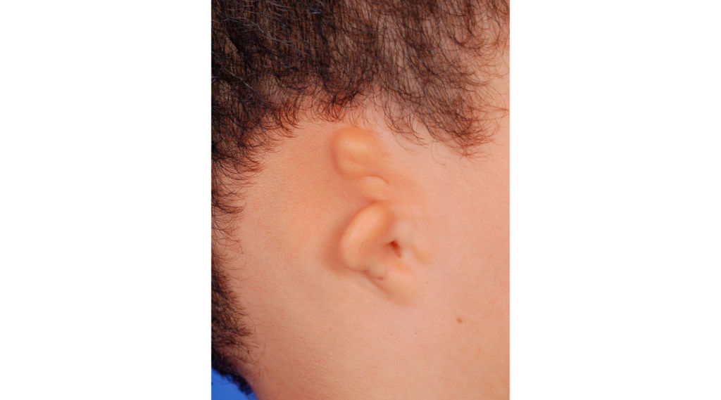 Malformação congênita nas orelhas, conheça os tratamentos