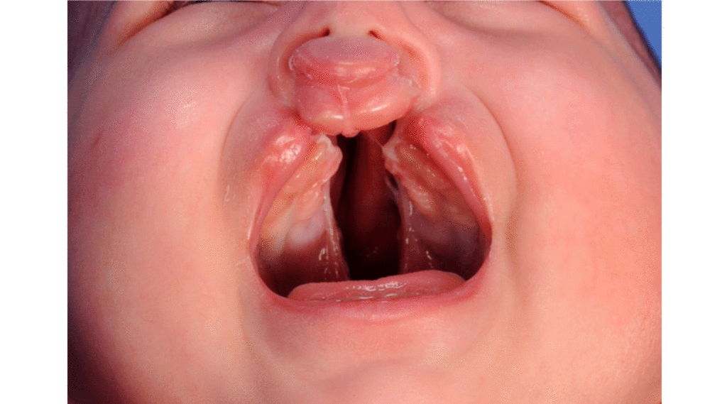 Queiloplastia, Rinoplastia e Palatoplastia: Conheça diferenças