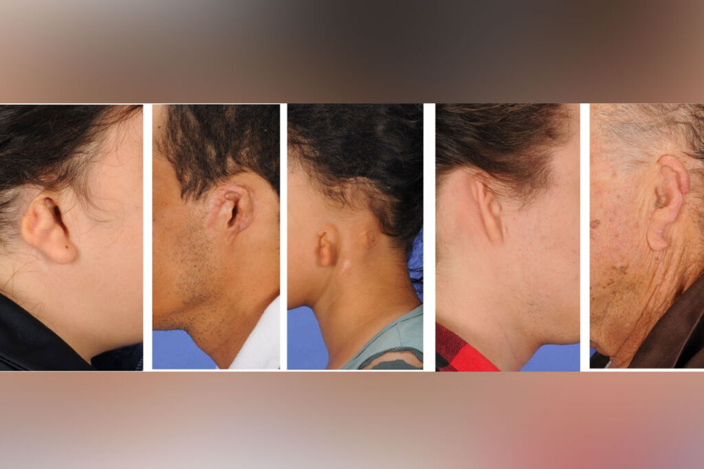 Orelha constrita: características e tratamento