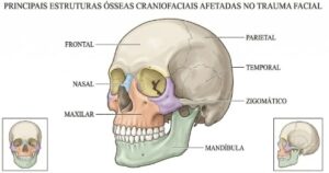 principais estruturas oddeas craniofaciais afetadas no trauma facial